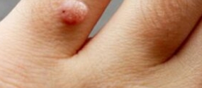 How to Remove Skin Tags and Warts Overnight: Safe and Effective Methods